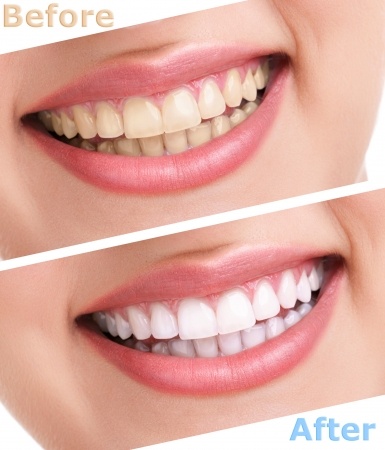 Laser teeth whitening or other whitening