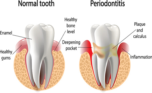 Periodontal Disease and Treatment